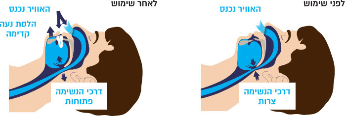 סד דנטלי נגד נחירות ,התקן דנטלי לנחירות , סד נגד נחירות מותאם אישית המורכב על השיניים בזמן השינה, התקן דנטלי להרכבה על השיניים למניעת נחירות, מכשיר ליישור הלסת בזמן השינה לנחירות בלילה Madosa Night Guard