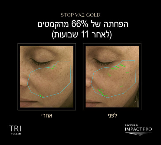 STOP VX2 GOLD מכשיר אנטי אייג'ינג ביתי הדור החדש