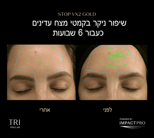 STOP VX2 GOLD מכשיר אנטי אייג'ינג ביתי הדור החדש