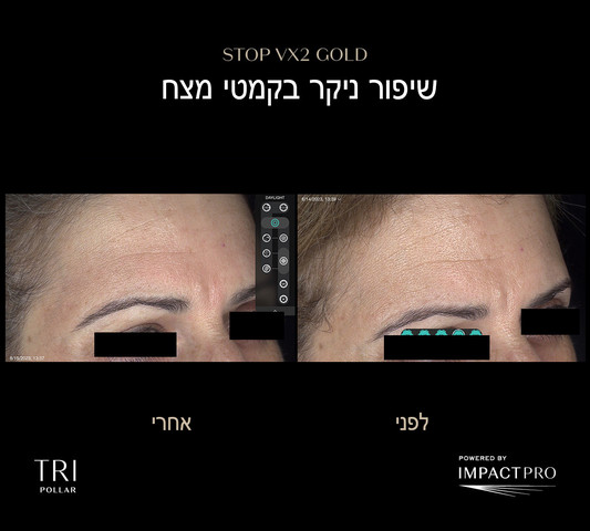 STOP VX2 GOLD מכשיר אנטי אייג'ינג ביתי הדור החדש
