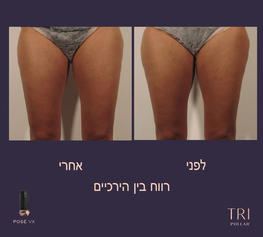 POSE VX2 מכשיר למיצוק עור הגוף