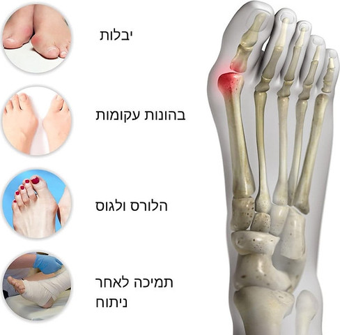 סד ליישור בוהן קלובה