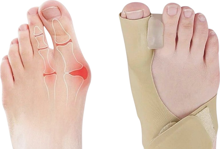 סד ליישור בוהן Toe Aligner
