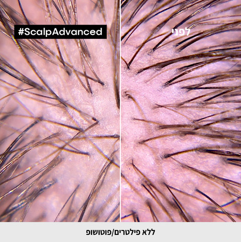 SCALP קרם מקצועי המסייע להעניק תחושת רוגע לקרקפת