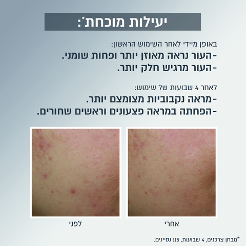 SKIN ACTIVE קרם לחות פחם למראה מאט והפחתת ברק שומני 3ב-1
