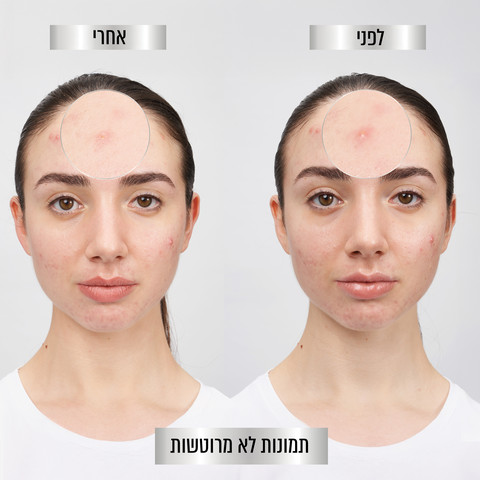 PURE ACTIVE מדבקות פצעונים