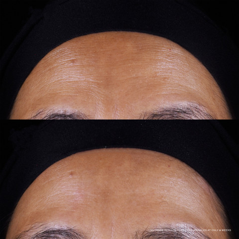 RENERGIE TRIPLE SERUM RETINOL סרום