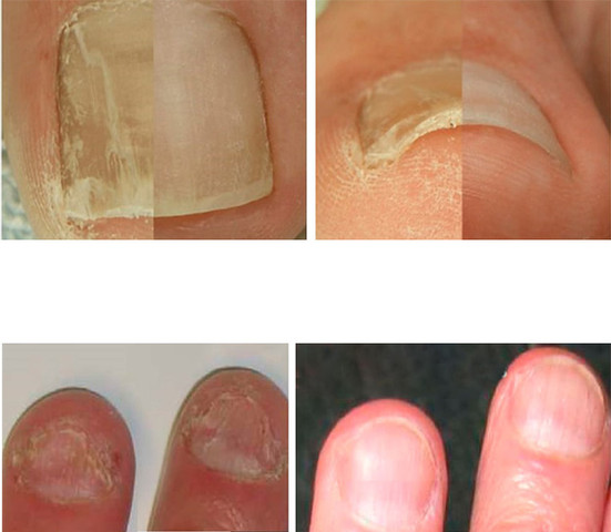 Nail Repair Serum סרום לטיפול בפטרת הציפורניים