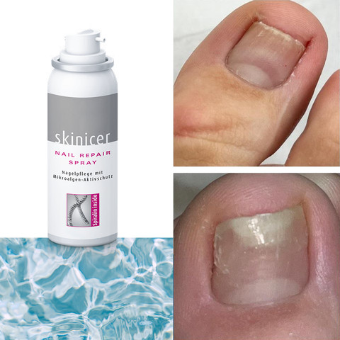 Spirularin® N Nail Repair Spray ספריי טיפולי אנטי-פטרייתי