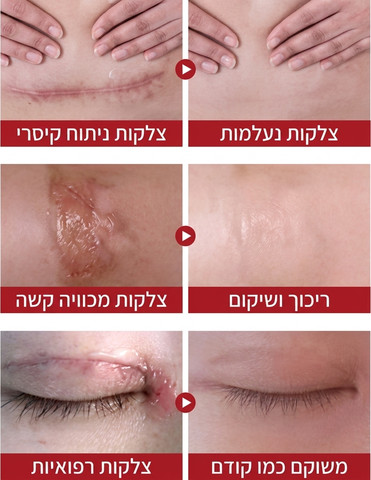 קרם סיליקון להפחתת צלקות anti scar, שיפור מראה צלקת ועור והחלמה מהירה