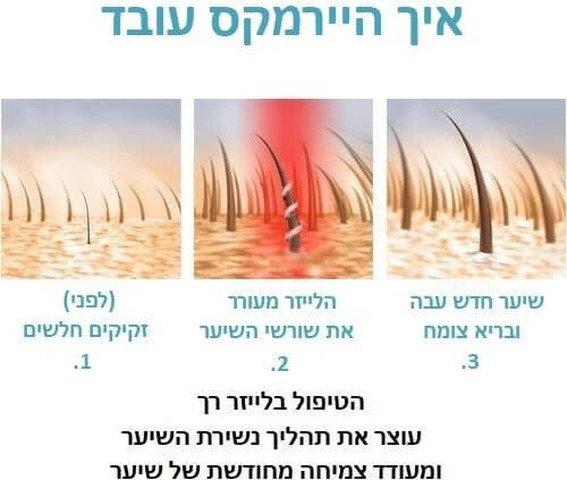 מברשת לייזר לטיפול בנשירת שיער והתקרחות HairMax הייר מקס Ultima 9